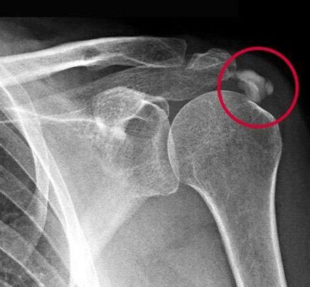 X-rays showed deposits of calcium salts in the joint