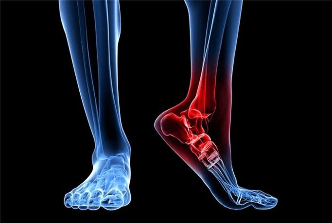 foot osteoarthritis