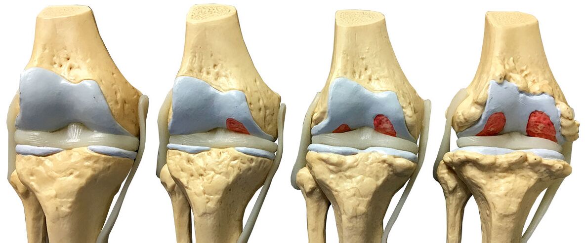 Knee joint arthrosis phase