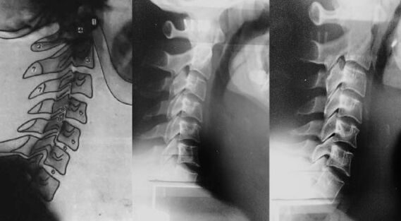 Neck with the movement of the first cervical vertebra