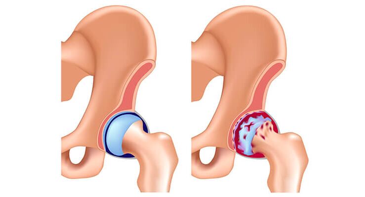 Arthrosis of the hip joint