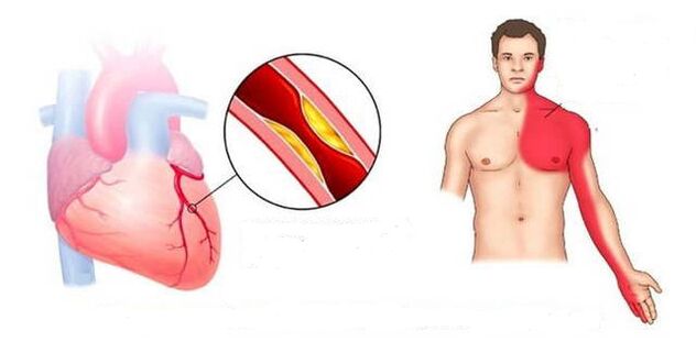 Cardial syndrome